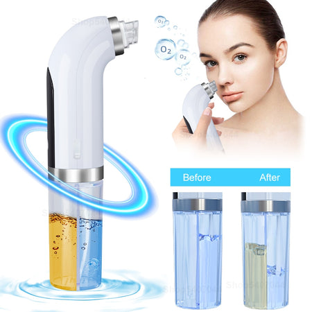 Microbubble Blackhead Remover