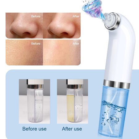 Microbubble Blackhead Remover